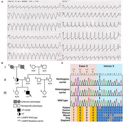 Case Report: A Novel LAMP2 Splice-Altering Mutation Causes Cardiac-Only Danon Disease